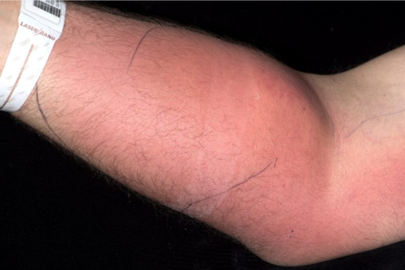 Illustration for article titled Se inyecta su propio semen en el brazo para curar un dolor de espalda. Acaba en el hospital